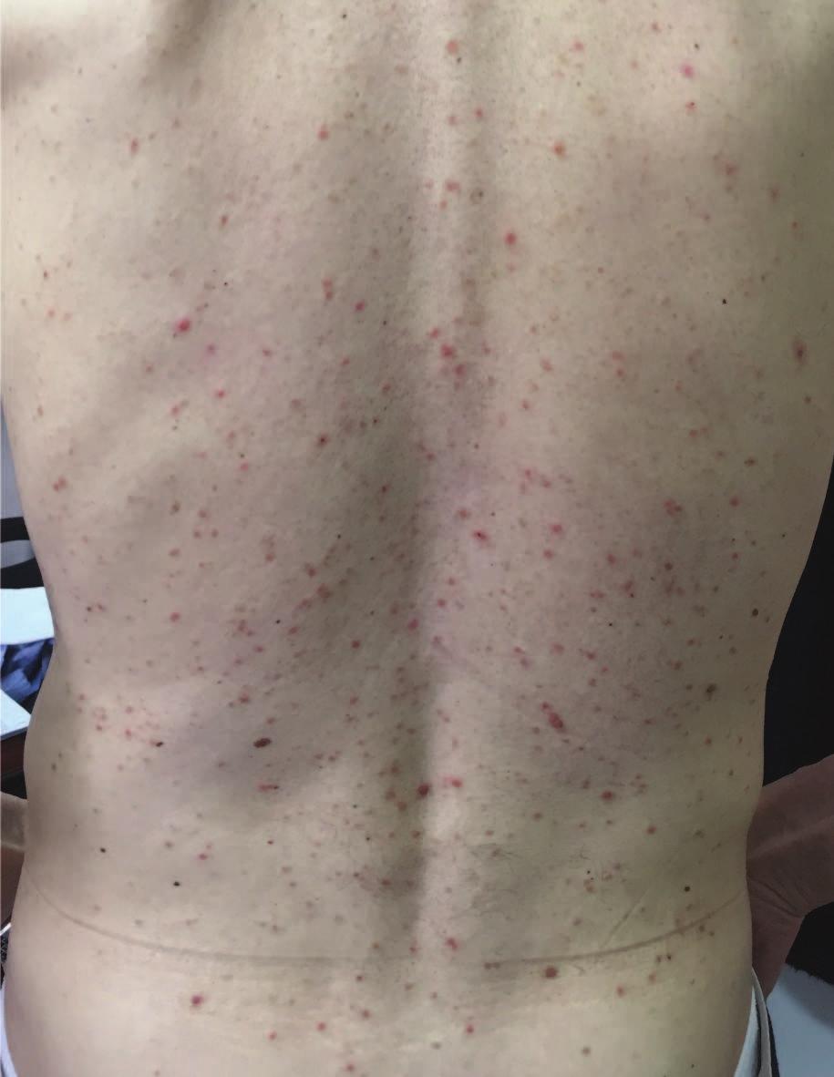 infiltrate of lymphocytes in the dermis The physical examination performed on admission found a normoponderal patient, with a stable cardiorespiratory status, BP 120/80 mmhg,