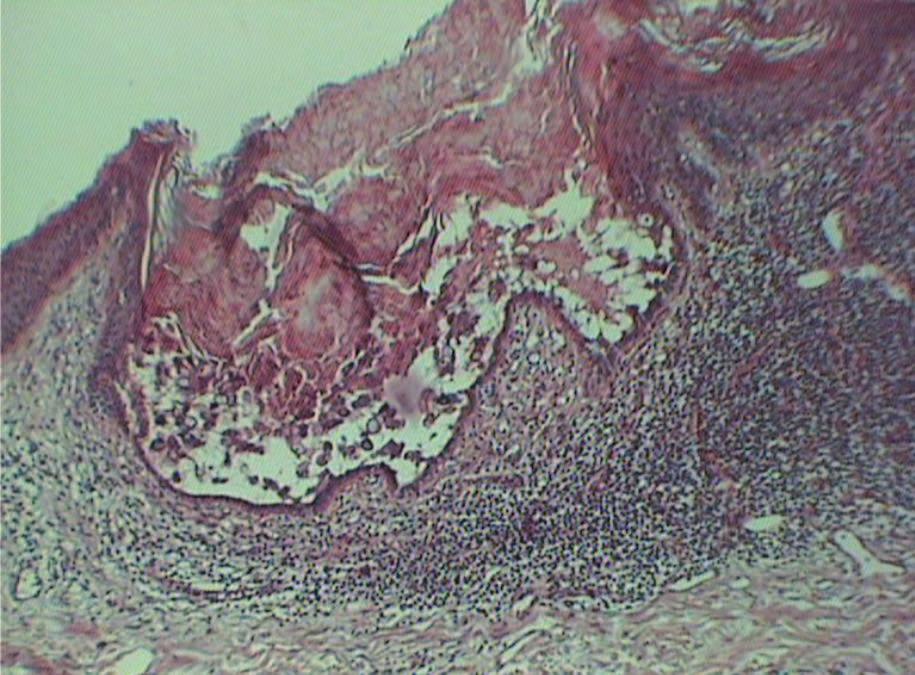A skin lesion biopsy was done and histopathological examination and direct immunofluorescence (DIF) were performed.