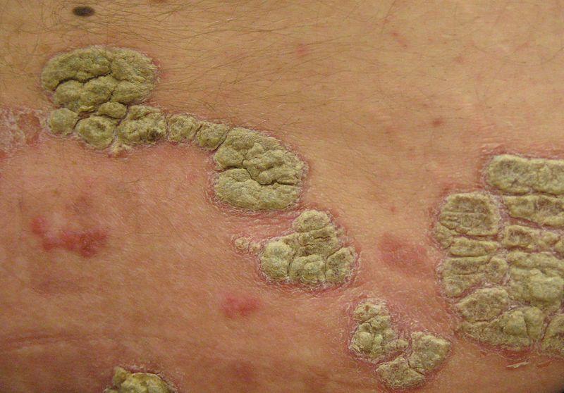 Psoriasis is inflammatory skin disease Characterizedby a red, scaly rash, which can be itchy A typical lesion is a well-defined