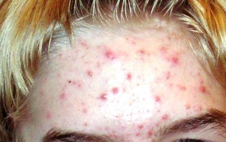 Presence of various spots called comedones (blackheads and whiteheads), papules, pustules, and, in severe cases, nodules and cysts.