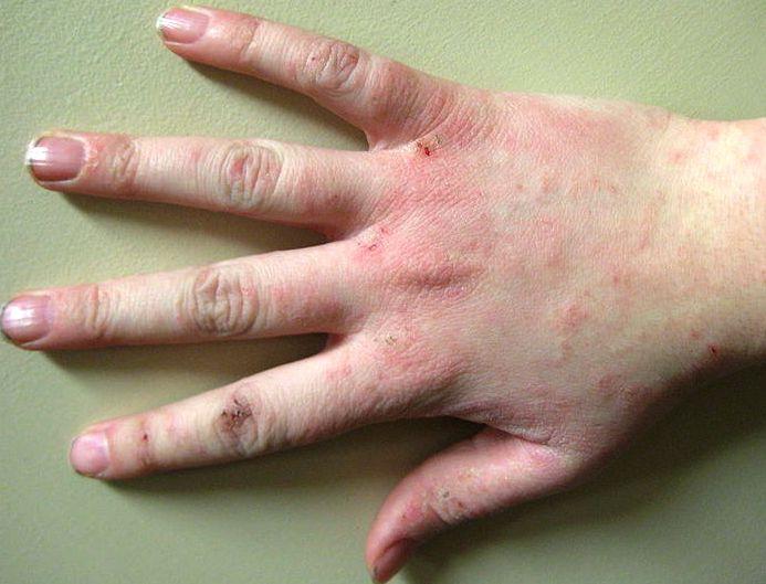 Dermatitis is inflammation of the skin (i.e. rash).