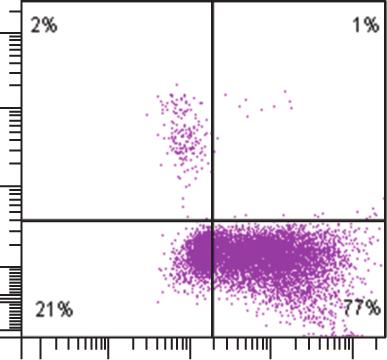 Standard immunophenotyping of leukemia cells in acute myeloid leukemia (AML) 45/14 CD45 FITC-A FSC-H 25 2 15 1 5 1 1 45/14 19/13 CD14 PE-A CD13 PE-A -239-132 -14 CD19 FITC-A 7/33 CD33 PE-A 1 1-185 11