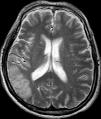 Neuroimaging Findings in CVD Multi-Infarct Dementia Strategic Infarct Dementia Large Vessel Cerebrovascular