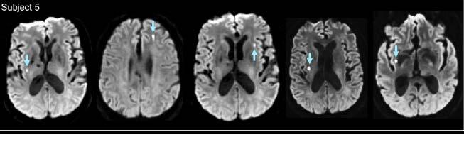 These lesions were clinically silent but had features of acute ischemic stroke.