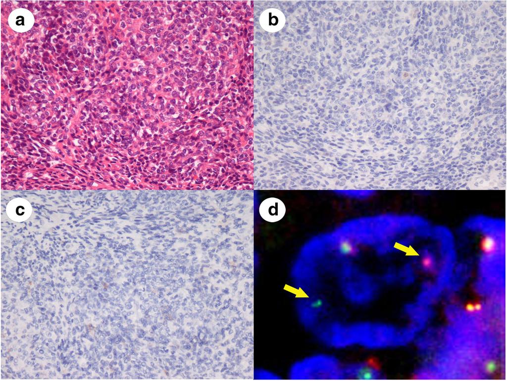 Sugita et al. Diagnostic Pathology (2016) 11:37 Page 5 of 6 Fig 2 Representative images of sarcomatoid carcinoma after synovial sarcoma was excluded.