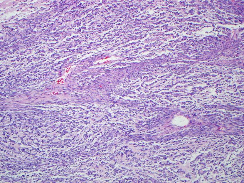 EWSR1 rearrangements Molecular genetics Partner FLI1, ERG, ETV1, EIAF, FEV, others ATF1, CREB1 NR4A3 WT1 DDIT3 POU5F1 Diagnosis Ewing sarcoma family of tumors Clear cell sarcoma Angiomatoid fibrous