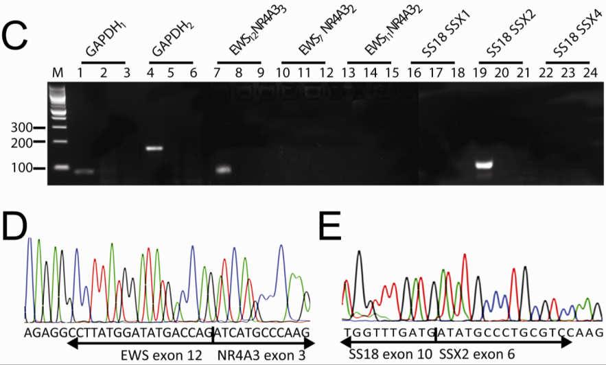 PCR: translocation High throughput assays Array based sequencing Vergara-Lluir M, et al. Am J Surg Pathol 2012; 36:1093 Pavlopoulos GA, et al.. BioData Min.
