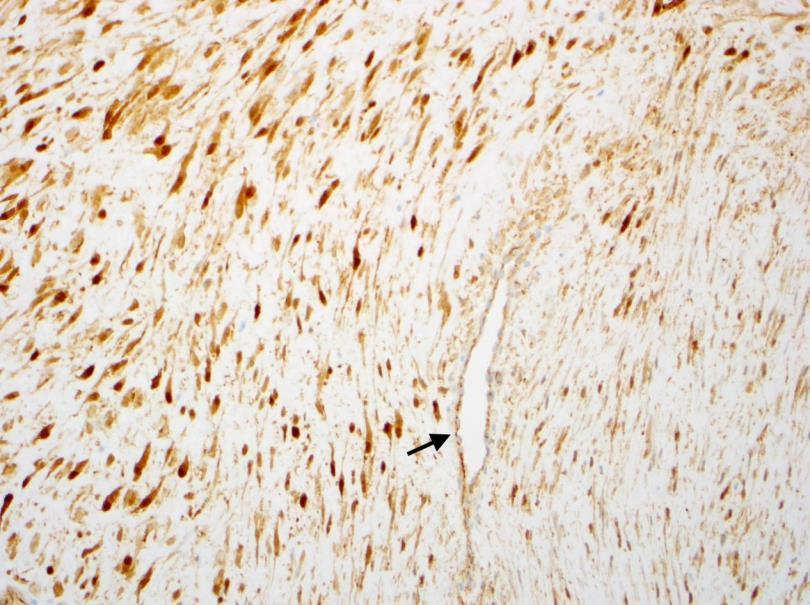 Rb (complete loss) IHC: Point mutation Spindle cell lipoma Rb β-catenin Encoded by CTNNB1 gene, Wnt signaling pathway Desmoid tumor: mutations in CTNNB1 (sporadic) or APC (Gardner