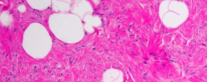 The spindle cells are CD34 positive. C. This tumor is characterized by loss of 16q. D.