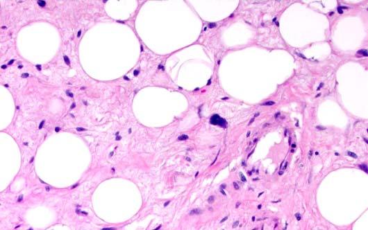 Atypical Lipomatous Tumor/Well- Differentiated Liposarcoma Most common form