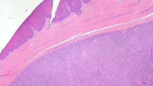 cytology with prominent macronucleoli Pleomorphism is uncommon; rarely seen in