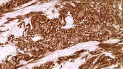 frequently neuroendocrine marker positive Ultrastructure Melanosomes Dense core