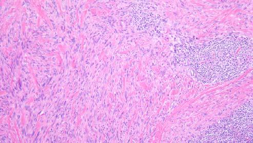 melanoma in situ or conventional melanoma Hyperchromatic spindle cells; may be