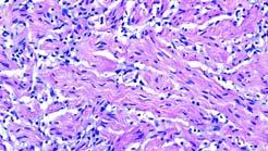2016 MFMER slide-19 2016 MFMER slide-20 2016 MFMER slide-21 Differential Diagnosis Neurofibroma Blue nevus Desmoplastic Spitz nevus Other sun damage-associated cutaneous spindle cell malignancies
