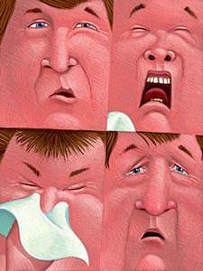 Allergic Rhinitis Signs and Symptoms Paroxysmal sneezing Pale, cyanotic, edematous (boggy) nasal mucosa Profuse watery