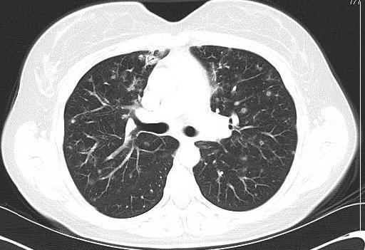 Bilateral, diffusely distributed nodules in lung and liver,