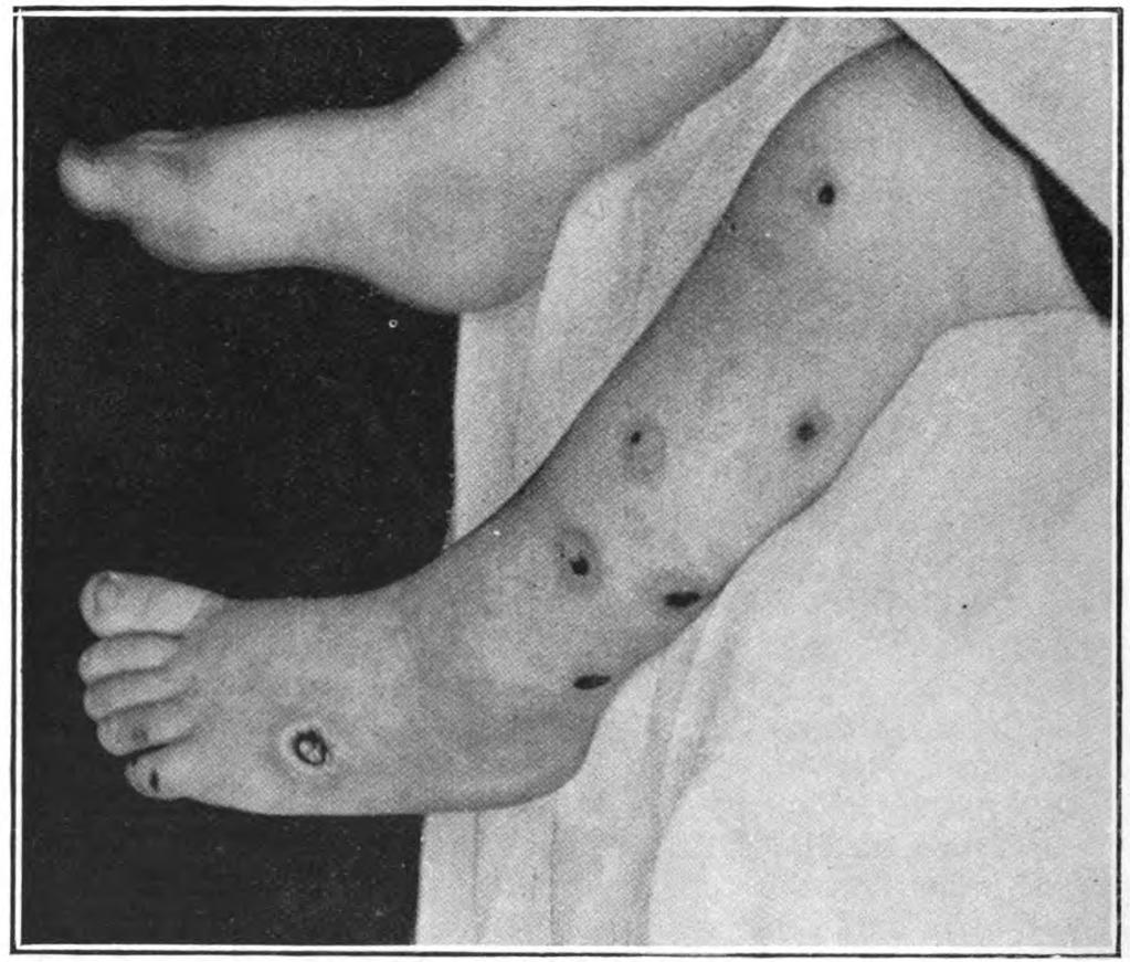 Bullous impetigo is caused by S. aureus, including CA-MRSA. The bacteria produce an epidermolytic toxin that causes separation of the dermal-epidermal junction, resulting in bullae.