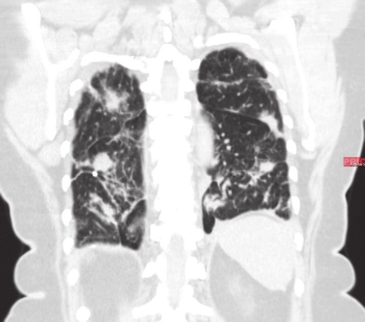 2 Case Reports in Gastrointestinal Medicine Figure 1: Computed tomography (CT) scan of the chest reveals diffuse parenchymal nodularity, with no honeycombing, hilar, or mediastinal adenopathy,