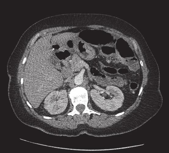 It usually occurs in patients in their fifth or sixth decade of life with evidence of multisystem sarcoidosis in approximately one-half of patients.