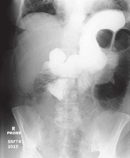 Case Reports in Gastrointestinal Medicine 3 (a) Figure 3: Gastrografin small-bowel follow-through demonstrated failure of contrast to pass into the colon.