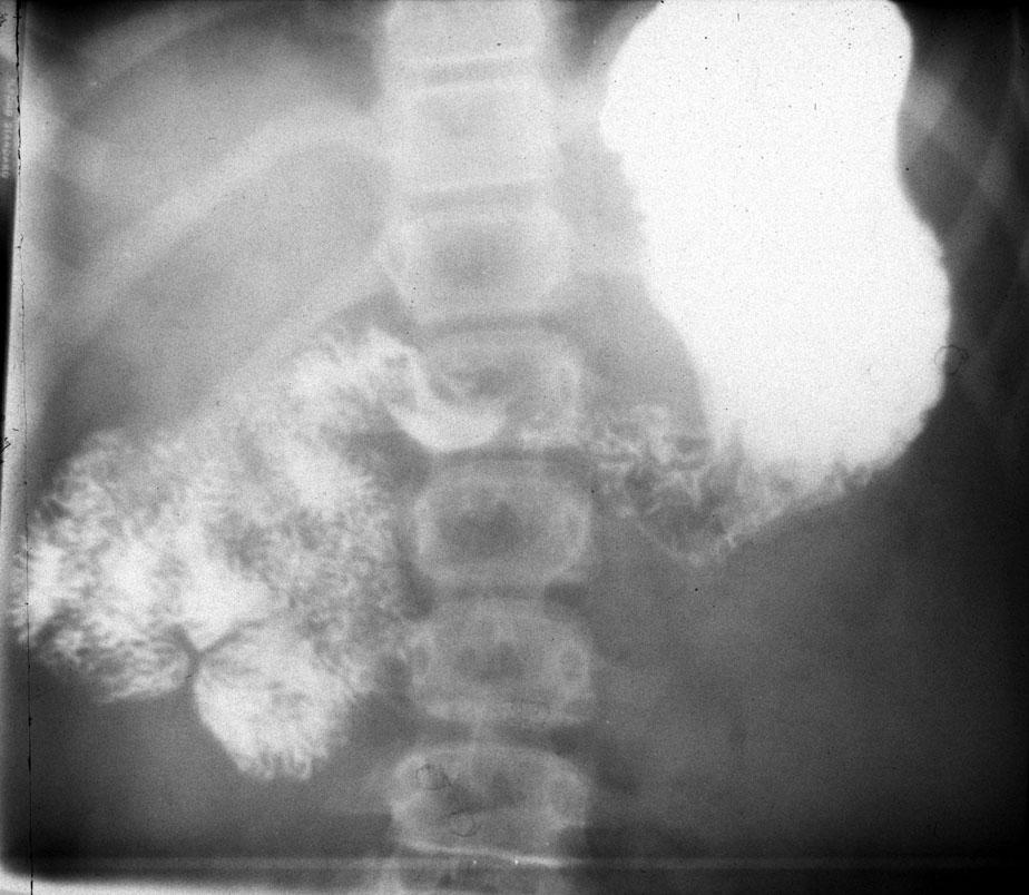 Case 2 The stomach and duodenal cap are under filled. The bowel lies on the right side, but is otherwise normal.