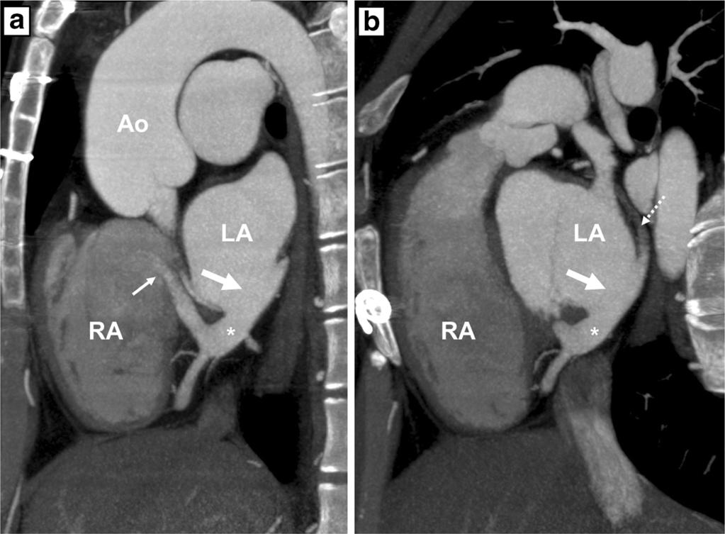 RA right atrium, RV right ventricle, LA left atrium and LV left ventricle 8 mm defect in the posterior part of the interatrial septum with bidirectional flow matching the diagnosis of ASD type UCS.