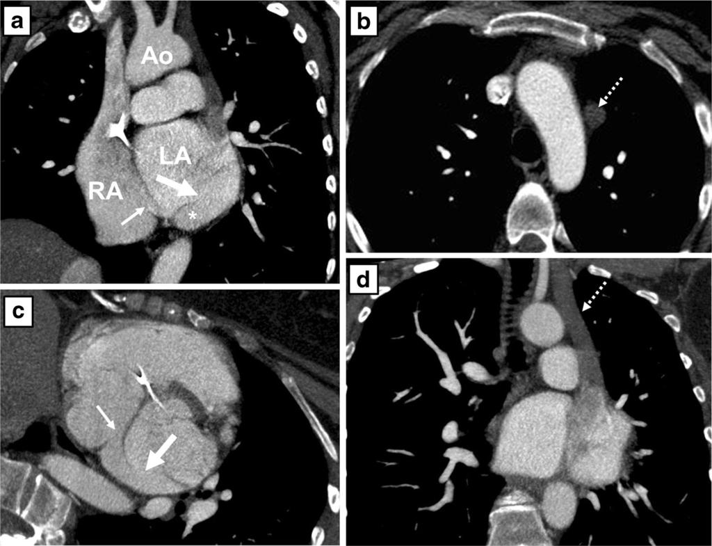 Neth Heart J (2014) 22:240 245 243 Fig. 5 Computed tomography angiography (CTA) images after intravenous contrast administration of patient B.
