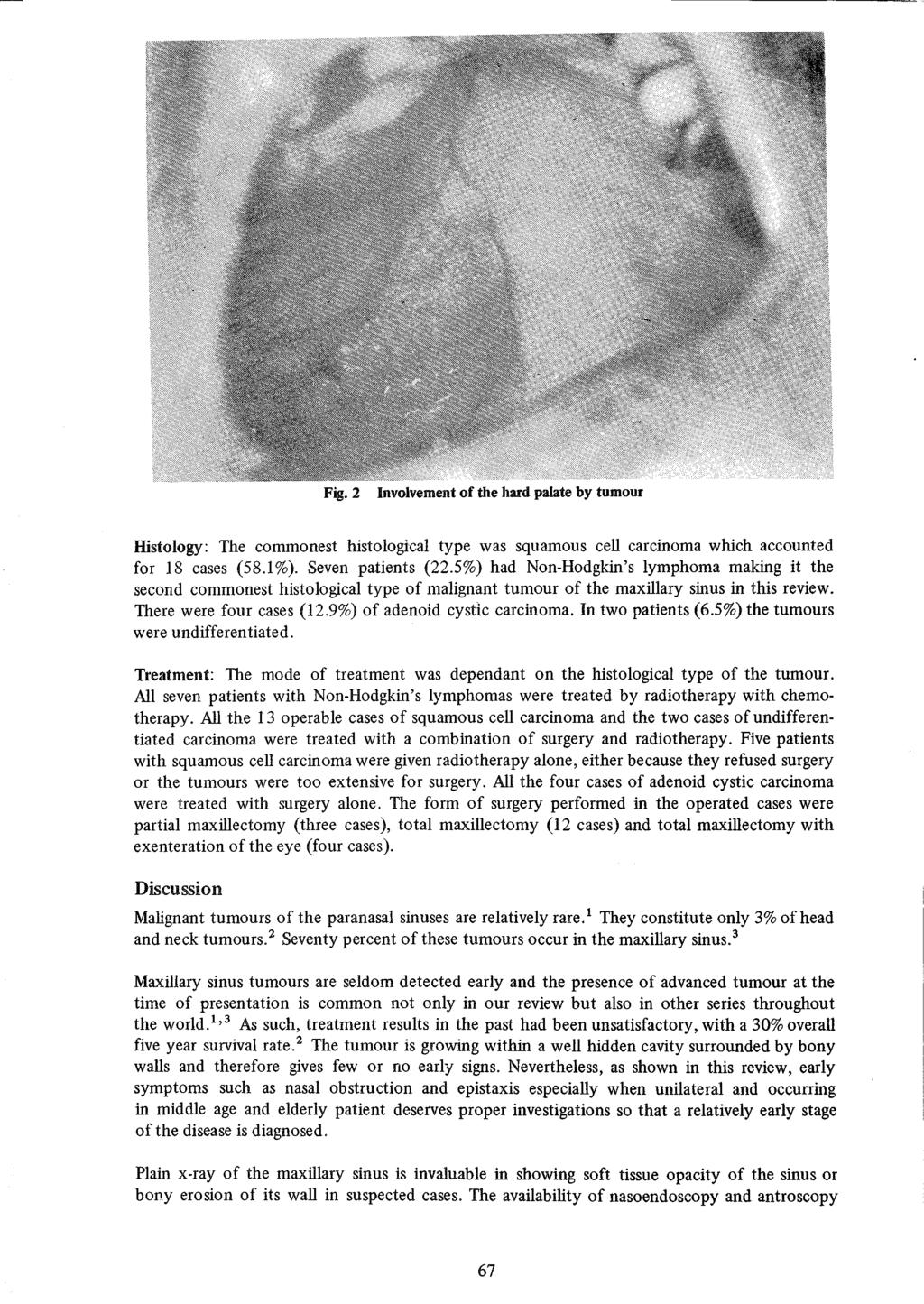 Fig. 2 Involvement of the hard palate by tumour Histology: The commonest histological type was squamous cell carcinoma which accounted for 18 cases (58.1%). Seven patients (22.