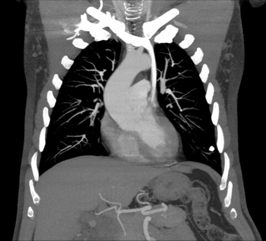 Fig. 7: 54 years-old male patient with a left SVC