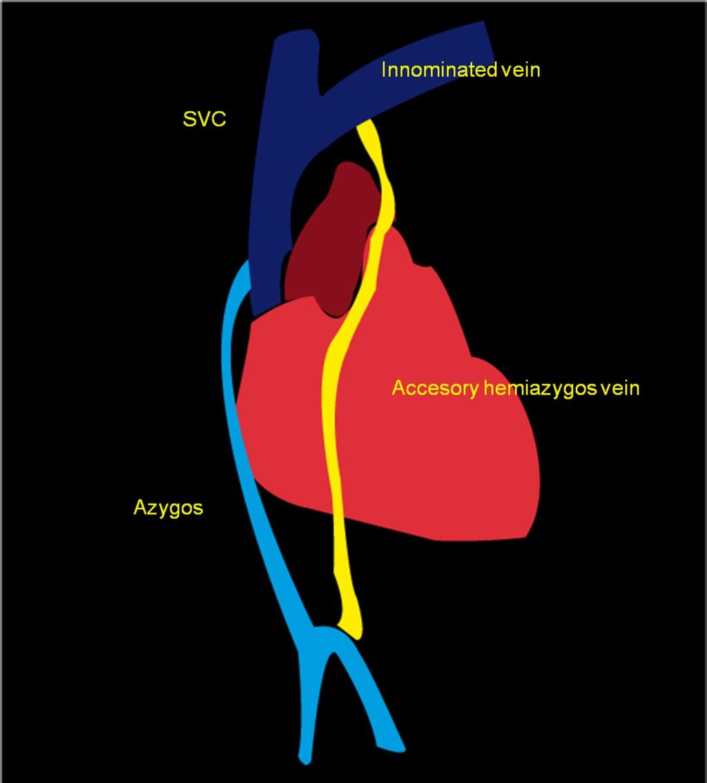 Fig. 9: The left superior intercostal vein communicates with the accessory hemiazygos vein in 75% of patients; it arches ventrally and drains into