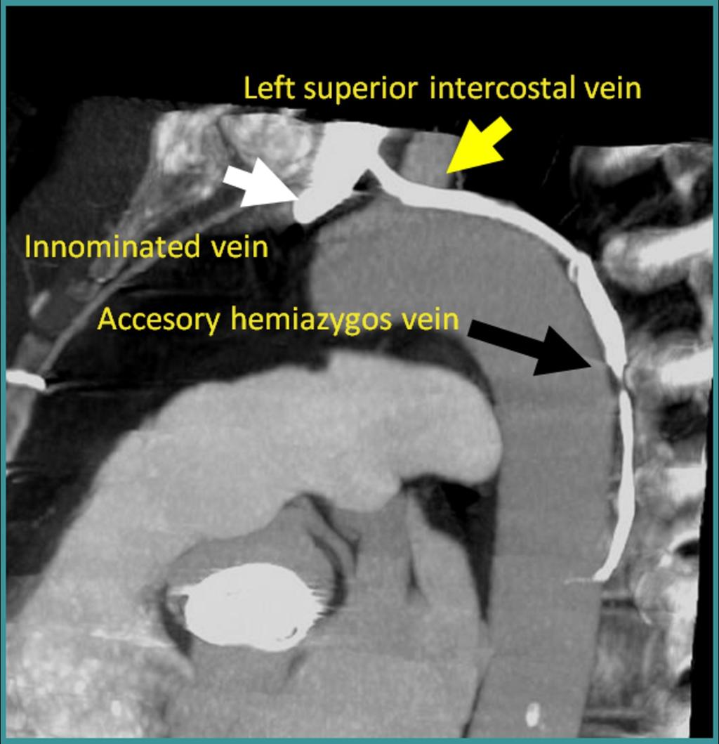 Fig. 11: MPR CT scan demonstrates the left superior intercostal vein (yellow arrow) draining into the