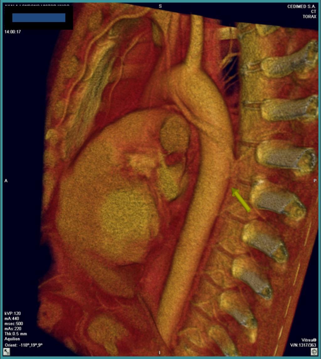 Fig. 13: 3D images demonstrating the accesory hemizygos vein