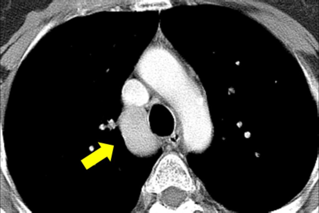 Fig. 14: Congenital interruption of the IVC with continuation of the azygos vein.