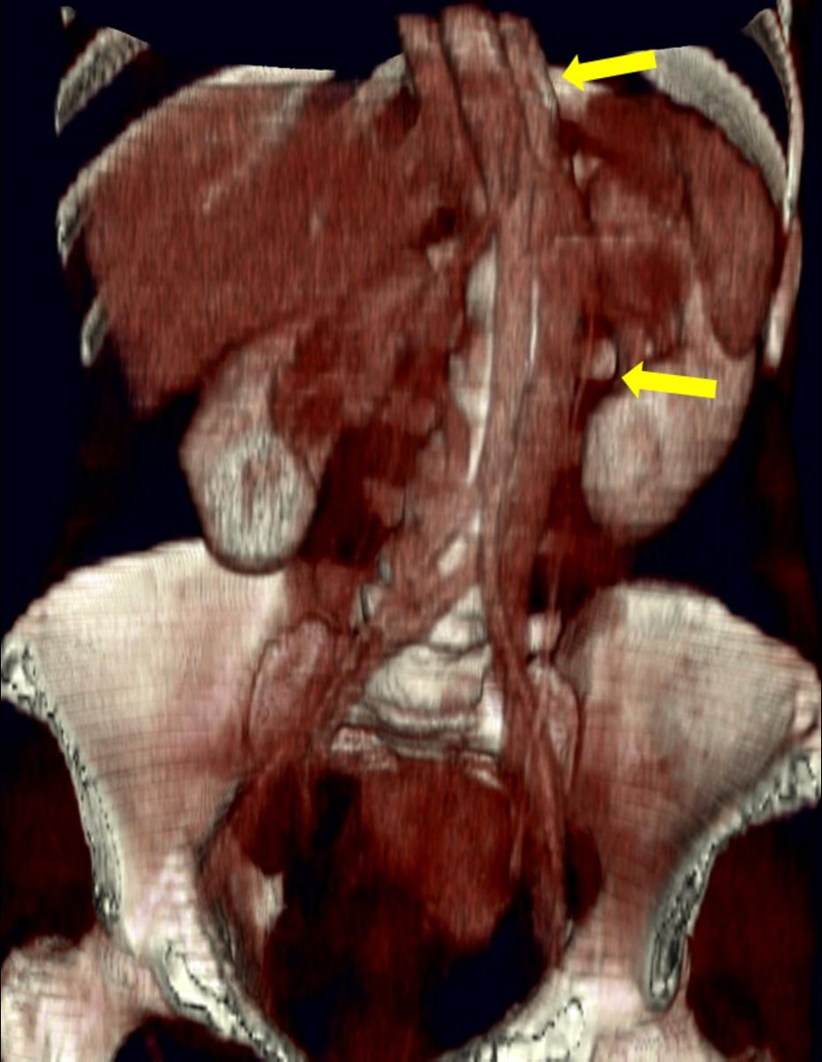 Fig. 17: Duplication of the IVC with hemiazygos continuation of the left IVC (yellow
