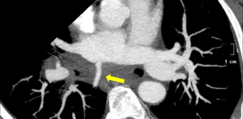 left atrium wall. Fig. 21: Supernumerary pulmonary vein.  left atrium wall. Fig. 22: Supernumerary pulmonary vein.