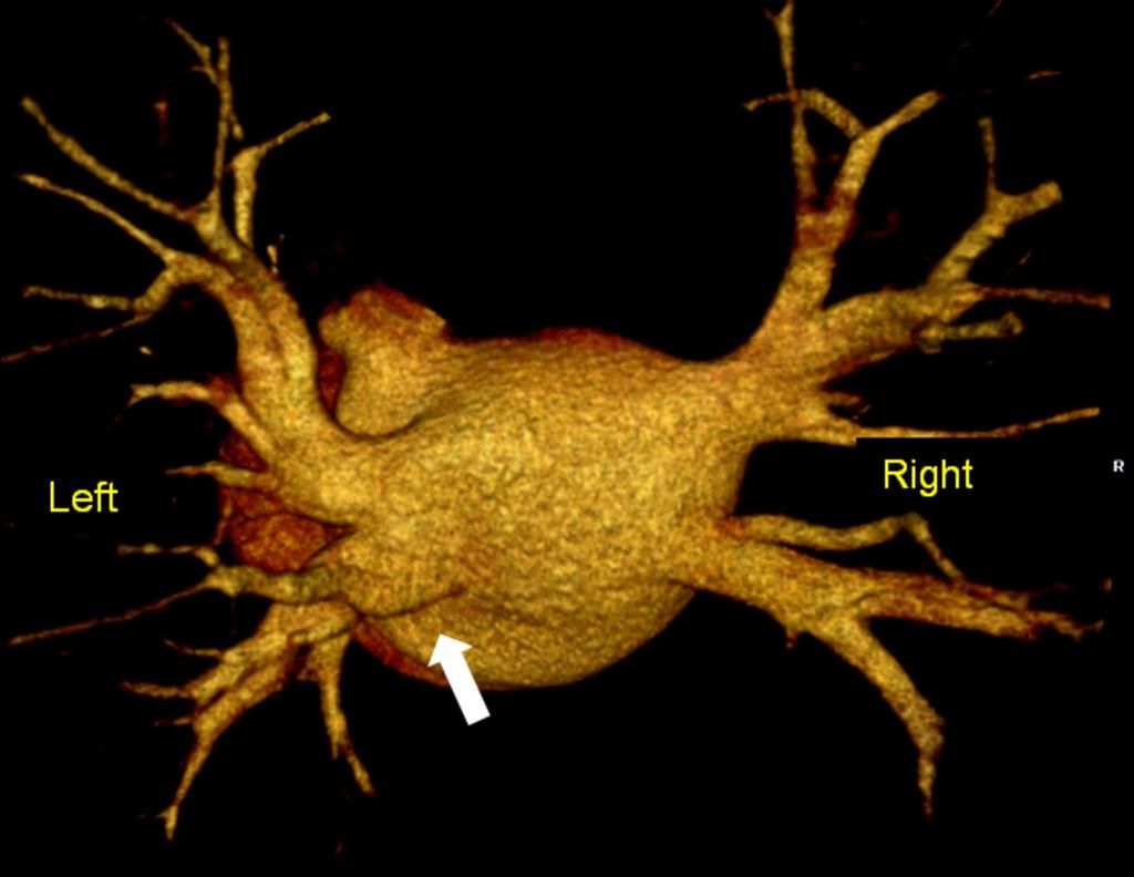 Fig. 23: Common ostia. Posterior view of CT volume-rendered image show a left common pulmonary vein ostia (arrows).