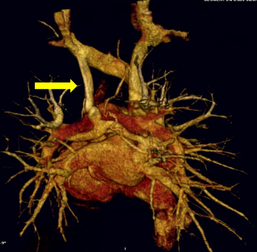 Fig. 25: 17 years- old patient with anomalous drainage of the superior pulmonary veins into a