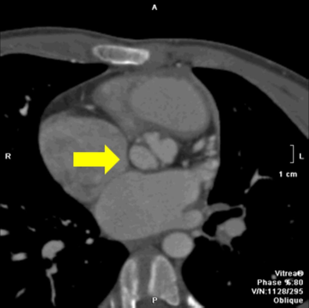 Fig. 26: 17 years- old patient with anomalous drainage of the superior pulmonary veins into a colector vein in the