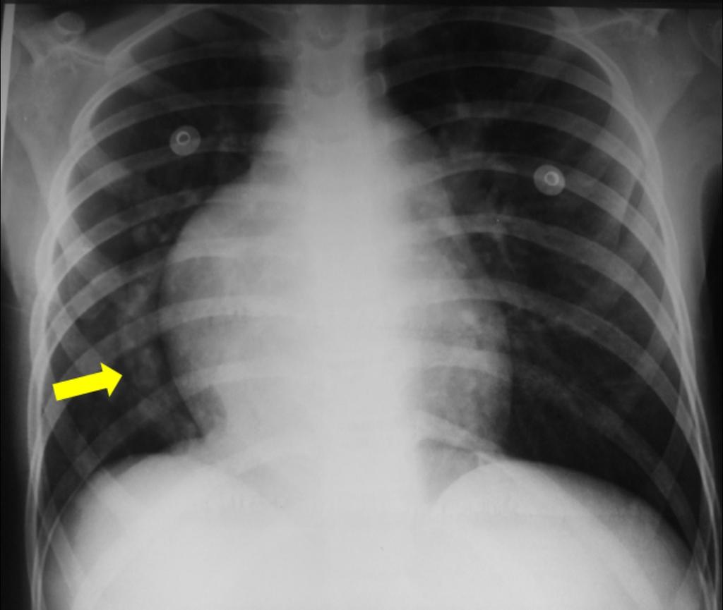 Fig. 28: Chest radiograph showing a vascular opacity draining from the right