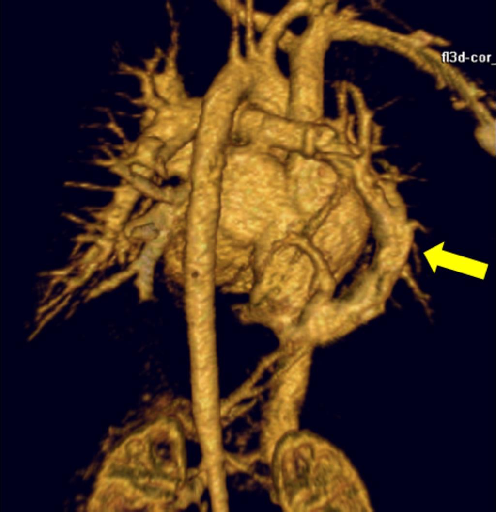 Fig. 30: 3D MIP images generated from a MRI multiphase angiogram provides an overall analysis of the