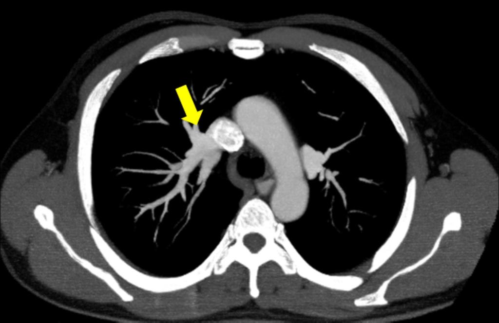 Fig. 31: Anomalous pulmonary vein from the right upper lobe in a 40 year-old man.