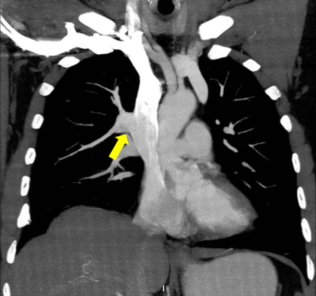 Fig. 32: Anomalous pulmonary vein from the right upper lobe in a 40 year-old man.
