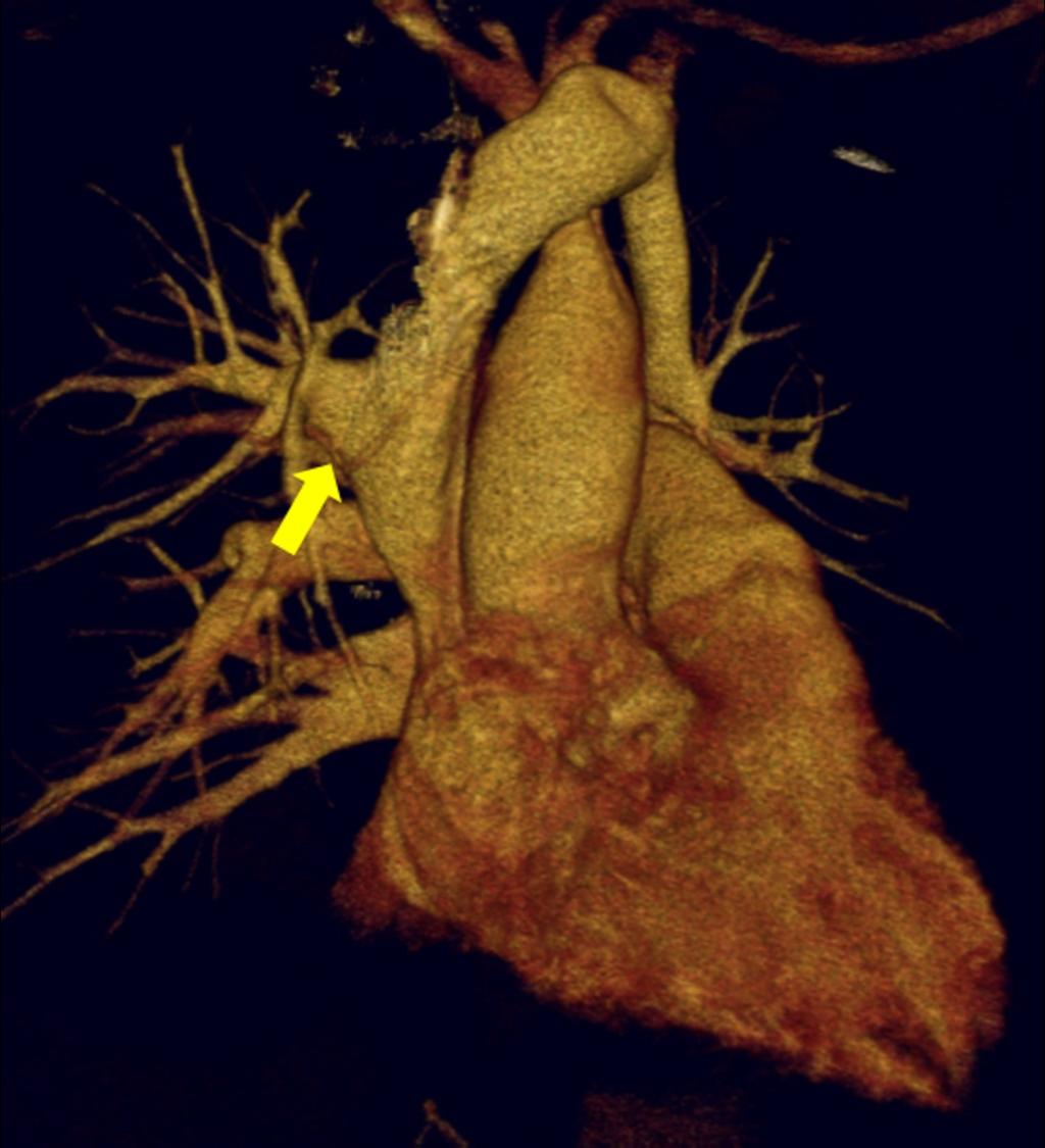 Fig. 33: Anomalous pulmonary vein from the right upper lobe in a 40 year-old man.