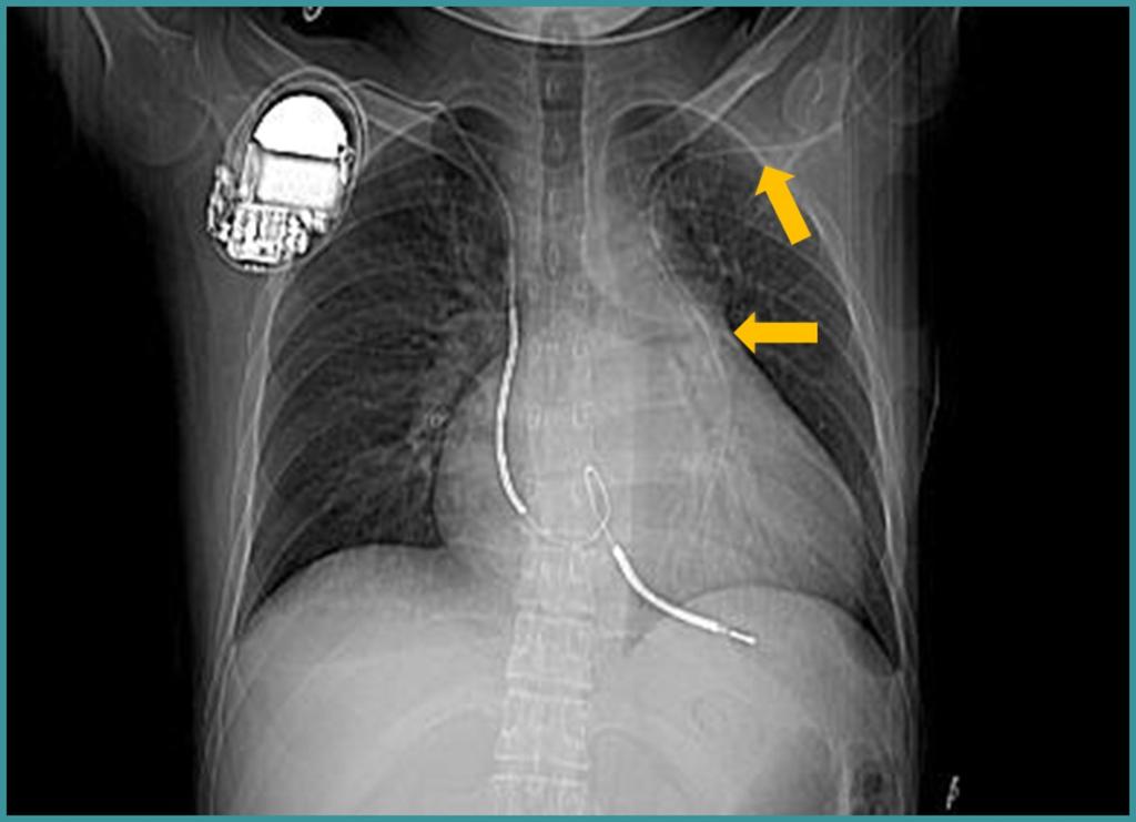 Fig. 34: Unusual position of a left subclavian IV catheter