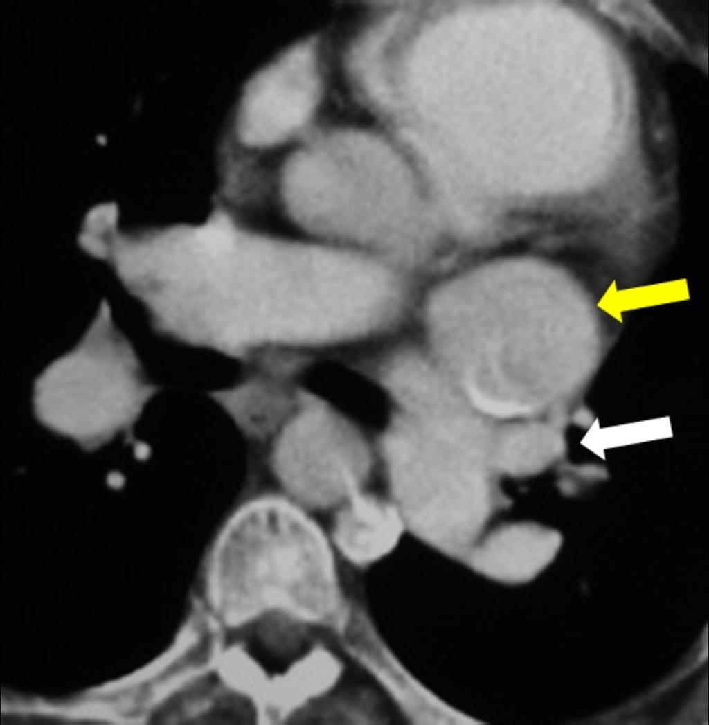 Fig. 37: Two vessels are seen anterior to the left main bronchus in persistent left superior