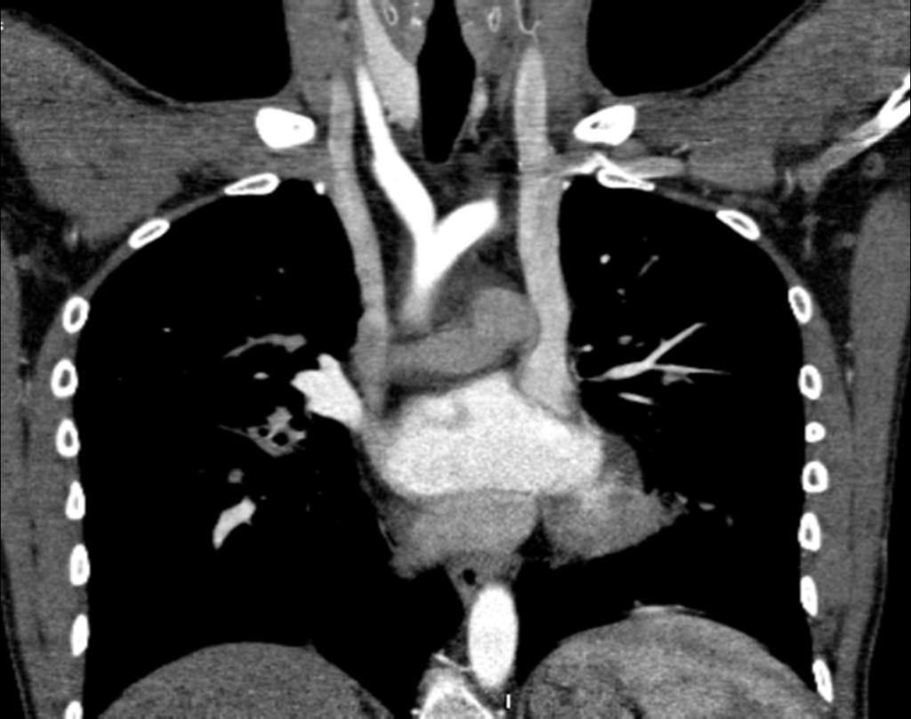 Fig. 3: 30-year-old man with duplicated superior vena cava (SVC).