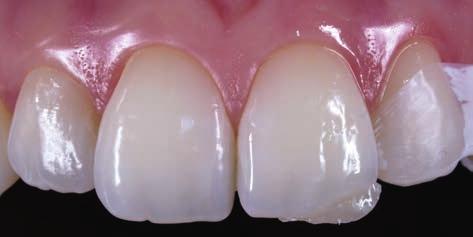 A thin layer of transparent composite, shade T1 (Venus, Heraeus Kulzer) was placed in the silicone matrix, and pressed