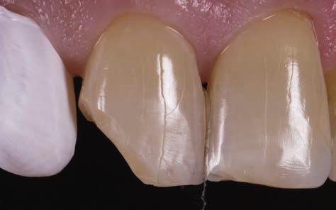 The way the filling was built up did not correspond to the shape of the natural tooth surfaces and therefore looked out of place. Fig.