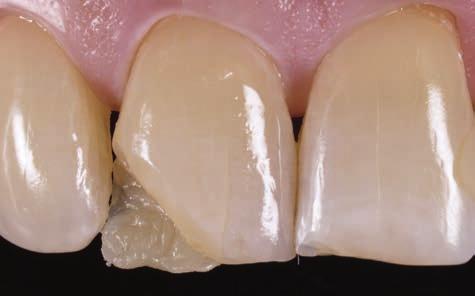Layering was extended up to the contact point of tooth 12, although the composite would not permanently bond with the surface of tooth 12 because it was not pre-conditioned.