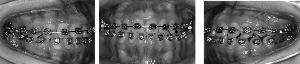 It was reported that, in these young patients, open-bite closure, molar intrusion with no incisor extrusion, upper occlusal plane clockwise rotation, and mandibular plane angle reduction